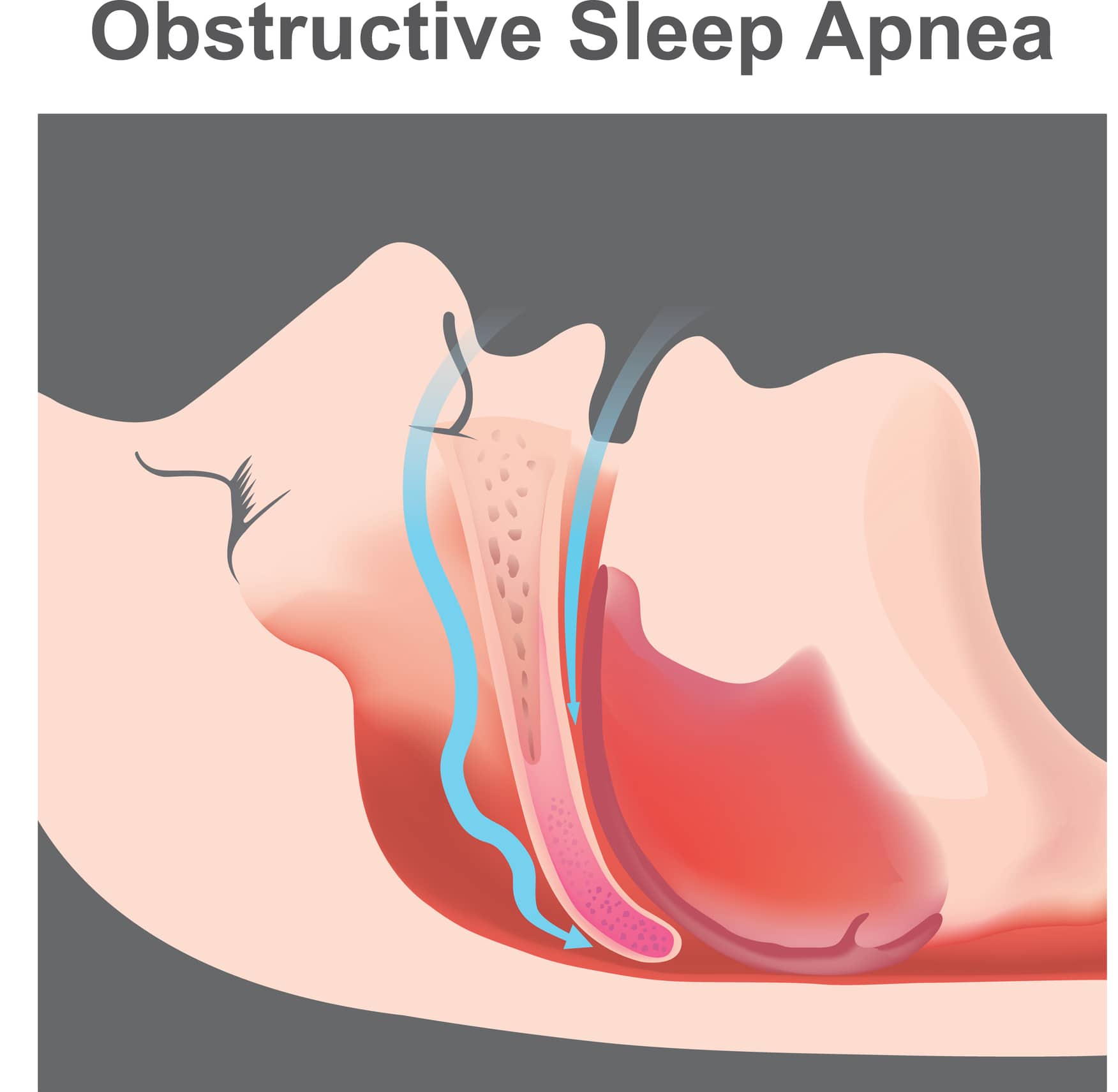 Can I get VA 100% for Sleep Apnea?